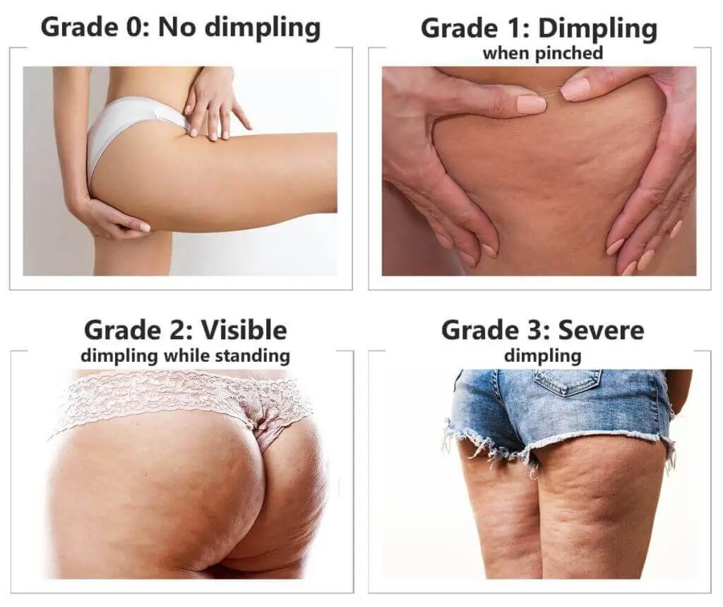 Representation of the stages of cellulite development Warminster